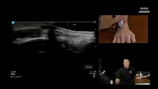 Ultrasound Evaluation of the Dorsal Wrist