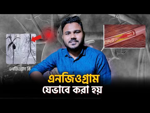 যেভাবে এনজিওগ্রাম করা হয় | What is angiogram? How is it done?