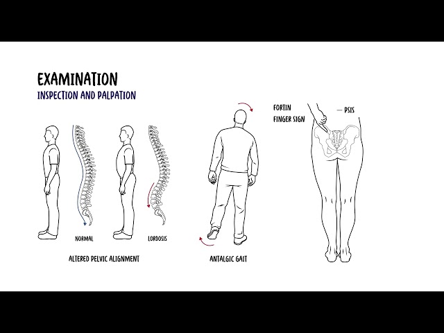 An Approach to Sacroiliac Joint Pain (SIJ PAIN) - history, examination and investigations