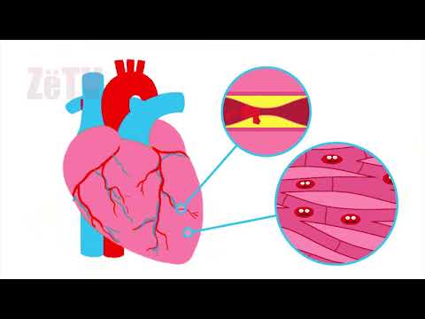 Infarkti i miokardit - "Kuriozitete e këshilla mbi shëndetin"