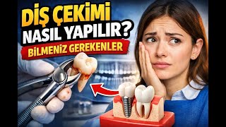 Diş Çekimi Nasıl Yapılır? Bilmeniz Gerekenler