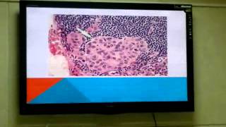 Dr.Sahar -Neoplasia 4 - Part 1 " Routs of tumor spread "