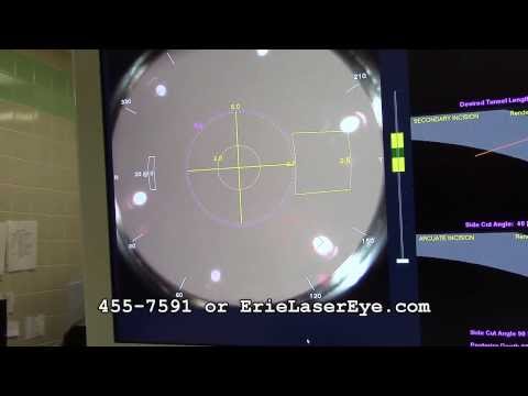 Laser Eye Surgery of Erie Laser Cataract Surgery