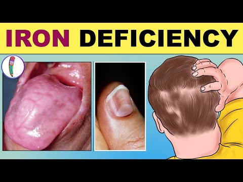 Iron Deficiency Anemia - Signs & Symptoms | Iron Deficiency - Early & Late Signs