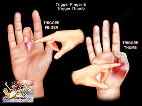 Trigger Finger & Trigger Thumb - Everything You Need To Know - Dr. Nabil Ebraheim
