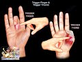 Trigger Finger & Trigger Thumb - Everything You Need To Know - Dr. Nabil Ebraheim