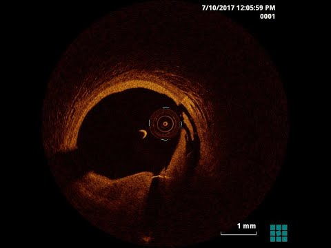 stent edge dissection