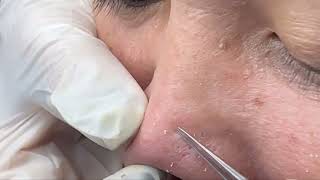 Remove blackheads simply with tweezers 4