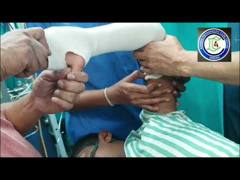 Fracture both bones forearm | Closed reduction under Short GA | Fiberglass plastering | Adamya HospV