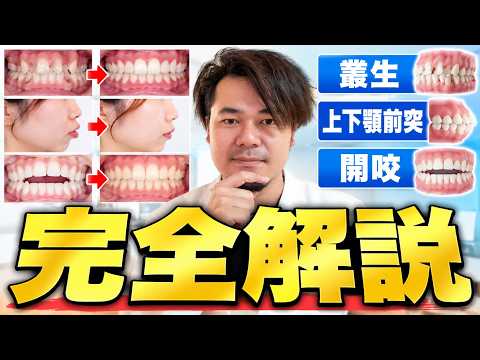 【完全解説】叢生(そうせい)、上下顎前突、開咬