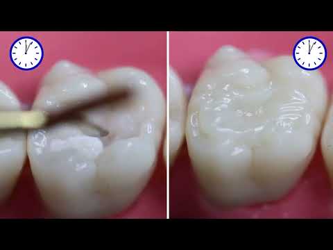 Tetric N Ceram Bulk Fill Ivoclar