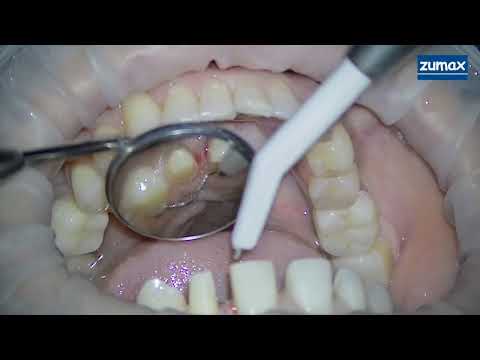 Препарирование фронтальных зубов под виниры