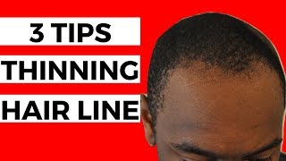 3 Tips For THINNING Hair Line | Black Men Balding