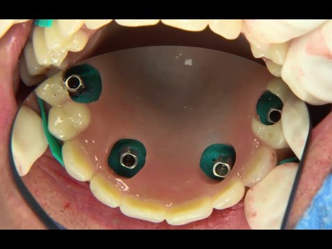 All-on-4® treatment concept clinical case: surgical procedure and denture conversion | Nobel Biocare