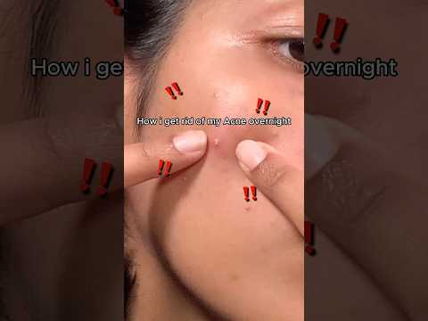 How I get rid of my acne overnight!! #skincare #skincaretips #acnetips #acneproneskin