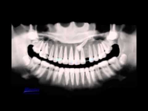Treatment of impacted canine