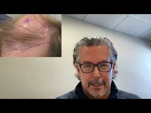WHAT happened to these 3 guy's hair transplant results? 3 no results elsewhere for repair thumbnail