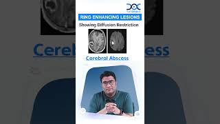 #QuickLearningBytes | Ring Enhancing Lesions by Dr Khaleel Ahmed - Radiology | DocTutorials