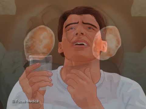 Tonsillitis - Respiratory - YouTube