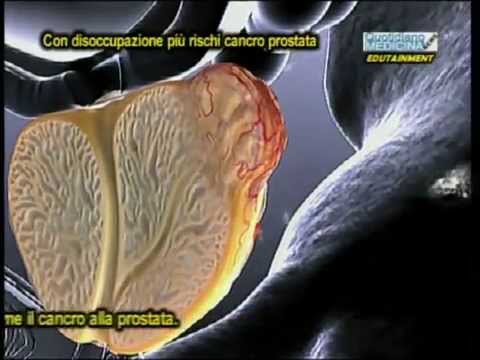 Baffi doro per il trattamento del cancro alla prostata Acquistare Prostamol Nizhny Novgorod