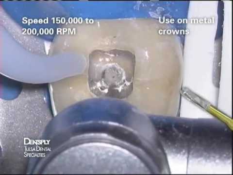 Transmetal bur clinical demonstration | Dentsply Sirona