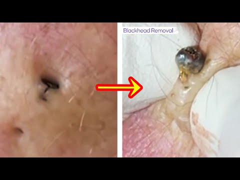Big Blackhead removal Video #11 #Blackheads #blackheadsremoval #sebum