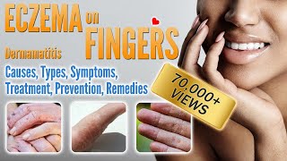 Eczema on Fingers Causes, Types, Symptoms, Treatment and Remedies |  Small Blisters and How To Treat