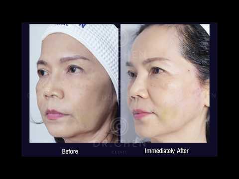 รีวิวร้อยไหมยกกระชับ หน้าตึงขึ้นมาก!! Dr.CHEN Surgery Clinic รีวิวร้อยไหมยกกระชับ หน้าตึงขึ้นมาก!! Dr.CHEN Surgery Clinic