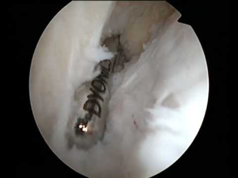 Fratture della colonna vertebrale toracica Osteocondrosi l1-s1 è