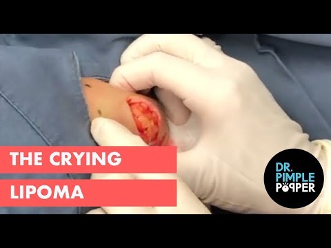 lipoma paraziták