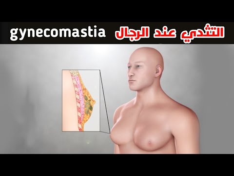 , title : 'التثدي عند الرجال (الاعراض -الاسباب-العلاج) _ men chest enlargement (gynecomastia)'