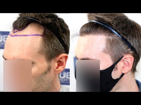 FUE Hair Transplant (1500 Grafts NW III A) By Dr Juan...