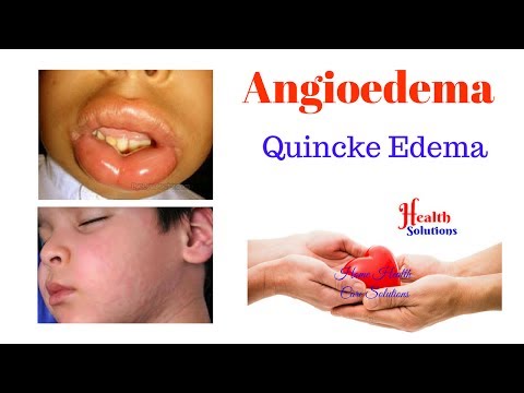 Angioedema - Quincke Edema Video