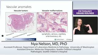 Malformations & Mosaicism: Role of Oncogenic Variants & Genetic Complexity in Developmental Lesion
