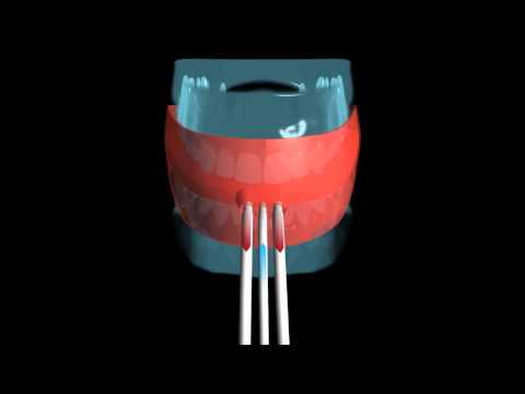 Disinfection of all 32 Parodonts with Plasma