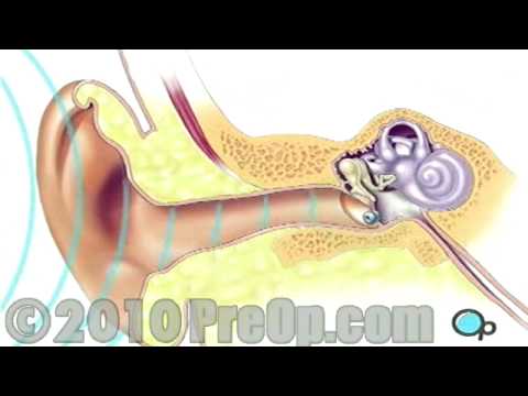 Myringotomie Einsetzen des Röhrchens PreOp® Patientenaufklärungsfunktion