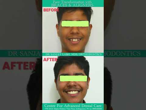 Before and After