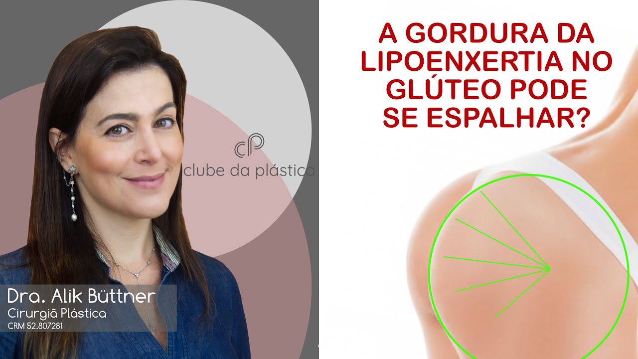 Clube da Plástica: A gordura da lipoenxertia no glúteo pode se "espalhar"?