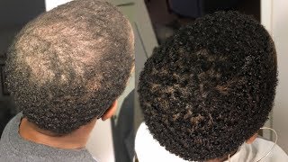 100% Natural HAIR REGROWTH Serum  | 2 Month Update - #GrowWithMe | Nia Hope