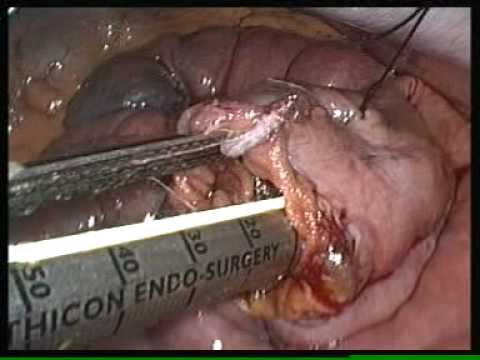 Laparoscopic Roux-En-Y Gastric Bypass by Dr. Deep Goel