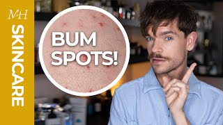 How To Get Rid Of Bum Spots