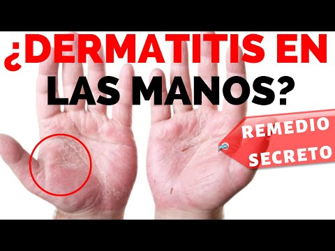 I semi di girasole è possibile a dermatite atopic Forum per bambini con dermatite atopic