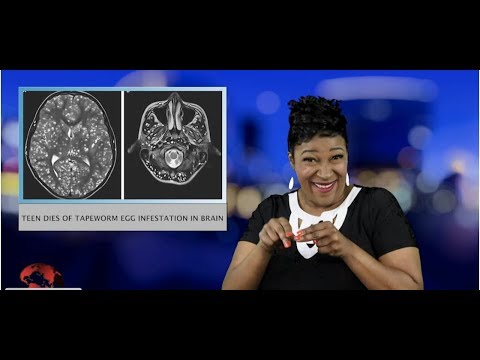 Teen dies of tapeworm egg infestation in brain (ASL - 3.29.19)