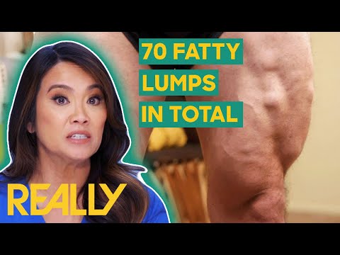 Dr. Lee Removes 27 Lipomas From A Patient's Body | Dr. Pimple Popper