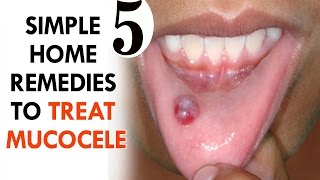 5 Home Remedies for a Mucocele (Mucous Cyst) | By Top 5.