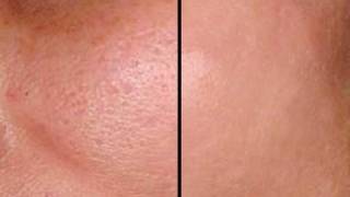 HOW TO: MAKE PORES DISAPPEAR IN SECONDS - GOOD FOR ACNE PRONE SKIN!