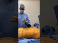 MICROAIRE PAL SMARTLIPO CPD UGFT PRP BBL BY DR GABRIEL PATINO 09 21 2020