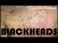 Blackheads Removal Full Video by Dr Lalit Kasana Blackheads Removal Full Video by Dr Lalit Kasana