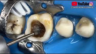 ¿Si la caries llegó al nervio de la muela que hacen después