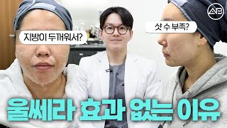 울쎄라 실패하는 케이스는?